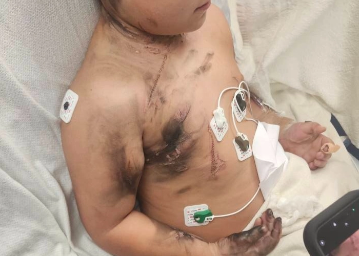 지난달 침대 위에서 감전 사고를 겪은 8살 소년 로렌조 로페즈. 온라인 모금 사이트 ‘고펀드미’ 캡처