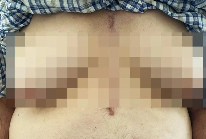 고혈압약 부작용으로 유방이 커진 76세 남성. 뉴잉글랜드의학저널