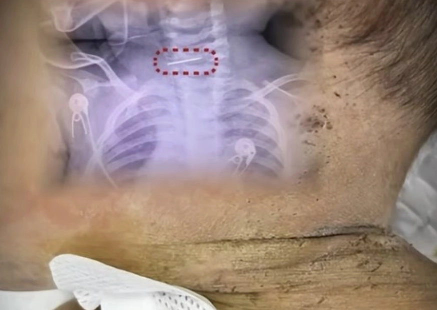 중국에서 생후 10개월 된 영아가 수백개의 바늘 자국으로 온몸이 뒤덮인 채 병원으로 급히 이송된 사건이 발생했다. SCMP 캡처