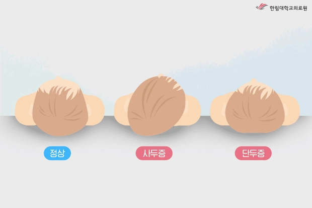 자세형 사두증의 유형. 한림대 동탄성심병원 제공