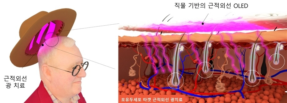 KAIST가 개발한 탈모 예방 OLED 기술 개념도. KAIST 제공