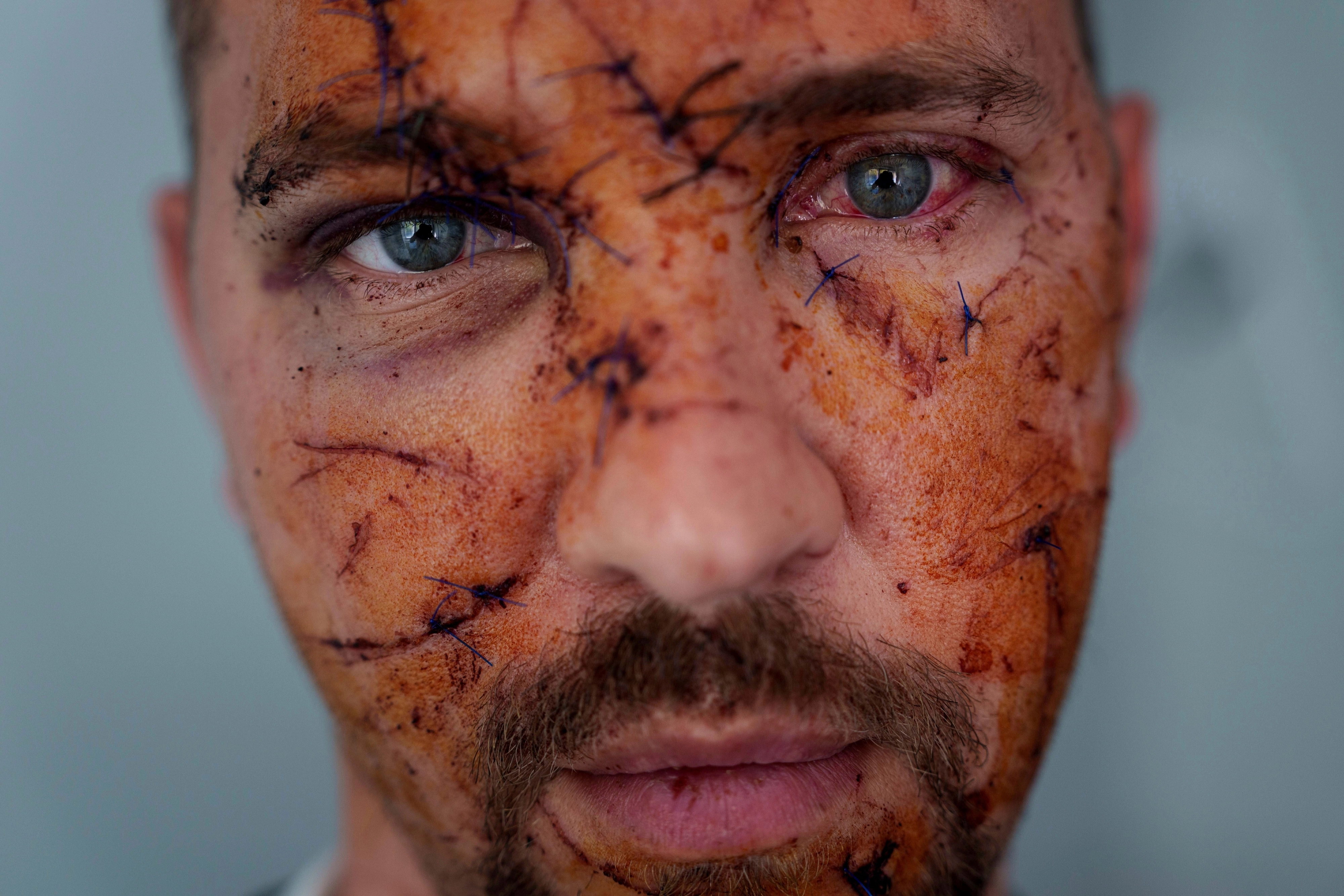 러시아군의 우크라이나 키이우 주택가 공습으로 다친 코스티안틴 비체크의 얼굴에 여러 군데 상처가 나 있다. 2025.4.25 키이우 AP 연합뉴스