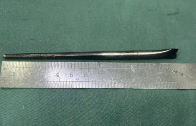 중국 남성이 삼킨 12㎝ 길이의 금속 젓가락. 어떤 경위로 삼키게 됐는지는 정확히 알려지지 않았다. 바이두