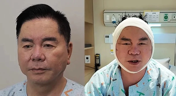 심형래 안면거상. 유튜브 캡처