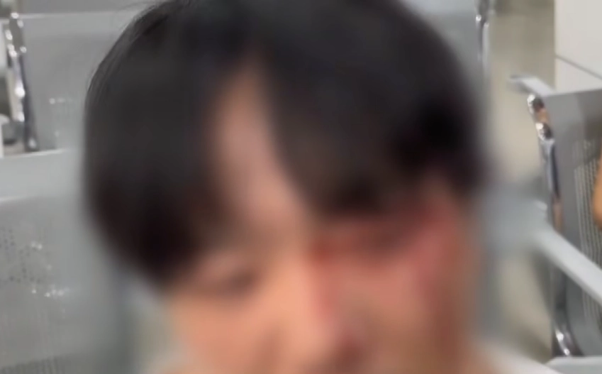 지난 3일(현지시간) 오전 태국 파타야의 해변에서 발생한 쌍방 폭행으로 안면 부상을 입은 일본인 남성 모습. 워크포인트뉴스23 유튜브 캡처
