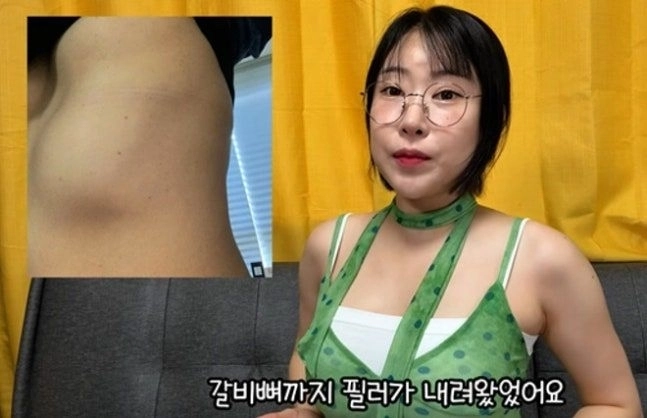 코미디언 이세영이 가슴 필러 시술 후 겪었던 부작용 사진을 공개했다. 유튜브 채널 ‘영평티비 YPTV’ 캡처