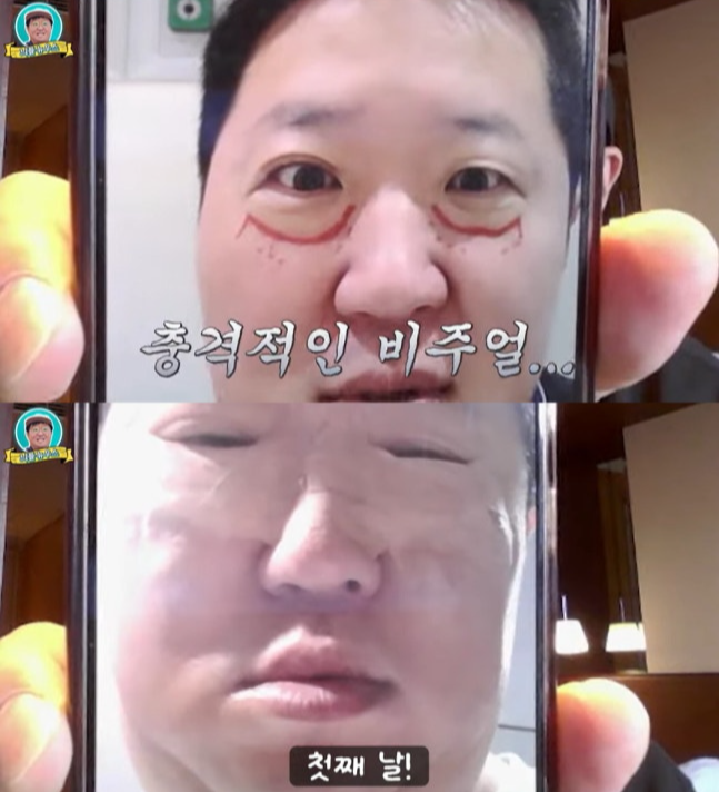 방송인 정형돈이 눈 밑 지방 재배치 수술 후기를 밝히며 수술 직후 퉁퉁 부은 사진을 공개했다. 유튜브 채널 ‘뭉친TV’