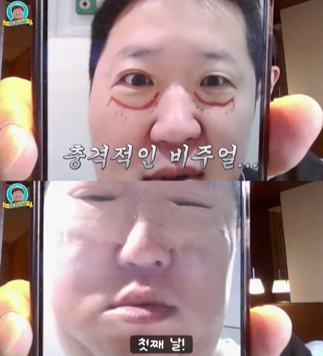 방송인 정형돈이 눈 밑 지방 재배치 수술 후기를 밝히며 수술 직후 퉁퉁 부은 사진을 공개했다. 유튜브 채널 ‘뭉친TV’