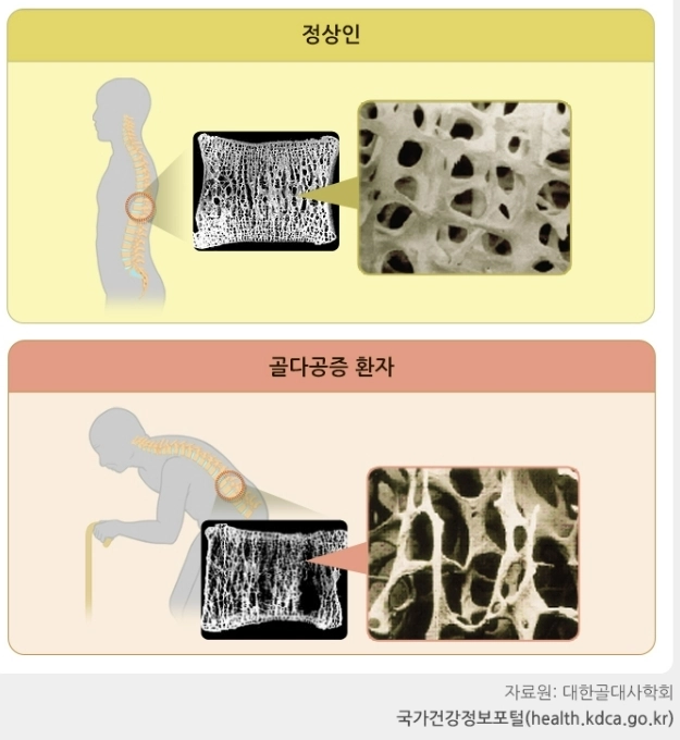 정상인과 골다공증 환자의 뼈 상태 비교. 질병관리청 국가정보포털 홈페이지 캡처.
