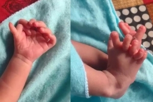 손가락 ‘14개’로 태어난 여자아이…부모가 기뻐한 이유