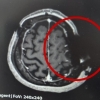 “MRI가 왜 이러지?”…유명 대학병원서 뇌수술 환자 머리뼈에 ‘톱날’ 콕