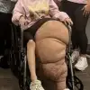 thumbnail - “한쪽 다리 무게만 80㎏”…2살 때부터 왼다리만 살찐 소녀, 결국 절단 수술