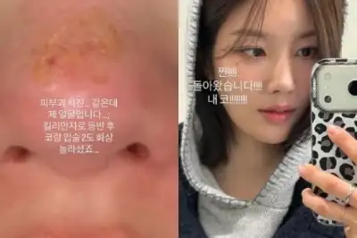 thumbnail - 권은비, “여행 중 얼굴에 화상” 어쩌다가…