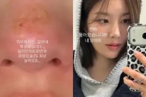 thumbnail - 권은비, “여행 중 얼굴에 화상” 어쩌다가…