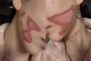 AOA 출신 권민아, 리프팅 시술 받다 ‘2도 화상’…충격적인 얼굴 상태