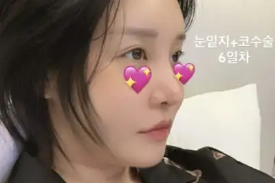 thumbnail - 랄랄, 눈·코 성형수술 받은 근황…몰라보게 달라진 얼굴