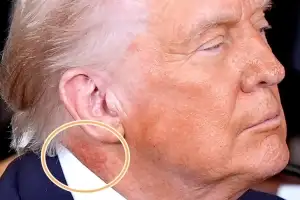 thumbnail - 79세 트럼프 목에 무슨 일? 붉은 반점에 건강 논란 재점화