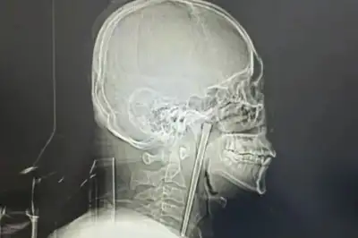 thumbnail - 술 마시다 12cm 젓가락 ‘꿀꺽’…수술 무서워 8년 버틴 中 남성, 결말은