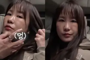 thumbnail - ‘김준호♥’ 김지민, 심각한 얼굴 상태…퉁퉁 붓고 멍 잔뜩