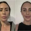 안면거상술에 2천만원 쓴 40대女 “더 늙어보인다” 충격 반응…전후 사진 보니