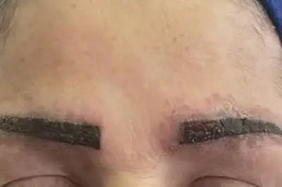 thumbnail - ‘눈썹 문신’했을 뿐인데…15개월 후 온몸에 ‘보라색 반점’, 원인은?