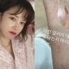 전효성, 손등까지 내려온 ‘붉은 반점’ 포착…이상 증상 호소