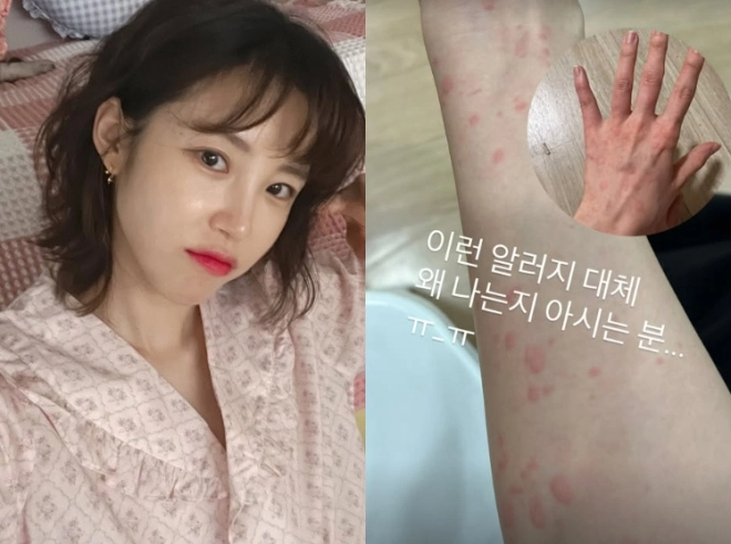 전효성, 손등까지 내려온 ‘붉은 반점’ 포착…이상 증상 호소