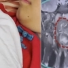 thumbnail - 6살 아들 목에서 6㎝ ‘쌍둥이’ 발견? 충격…의료계 “기생 쌍둥이와 달라” 中 ‘발칵’
