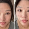 thumbnail - 쌍커풀 수술했다가 “평생 눈 못 감아” 청천벽력 부작용…돈까지 토해낸 中 여성