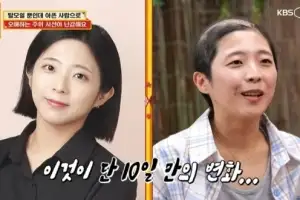 thumbnail - “10일만에 급성탈모” 33세 여성인데 ‘대머리’ 충격 공개… 병원 가봤지만