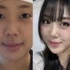 thumbnail - “피곤한 인상에 4년 고민” 이영지, 확 달라진 얼굴…인상 바뀐다는 ‘이 시술’ 연예계 열