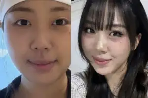 thumbnail - “피곤한 인상에 4년 고민” 이영지, 확 달라진 얼굴…인상 바뀐다는 ‘이 시술’ 연예계 열풍