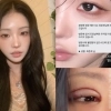 최준희, 눈 재수술 근황…“최고의 버전으로 