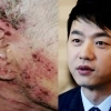 “포크로 긁는 고통” 수포 뒤덮은 얼굴…김승수, 실명 위기 온 ‘이 병’ 뭐길래