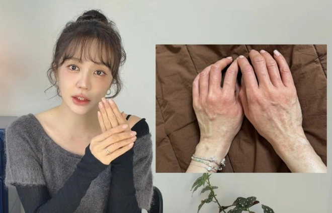 윤은혜, “손 붉어지더니 붓기 시작”…알고 보니 심각한 반응