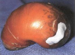 치과 치료에 쓰는 접착제로 달팽이의 부러진…