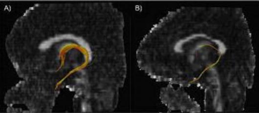 일반인의 뇌(왼쪽)와 대구 지하철 참사 생존…