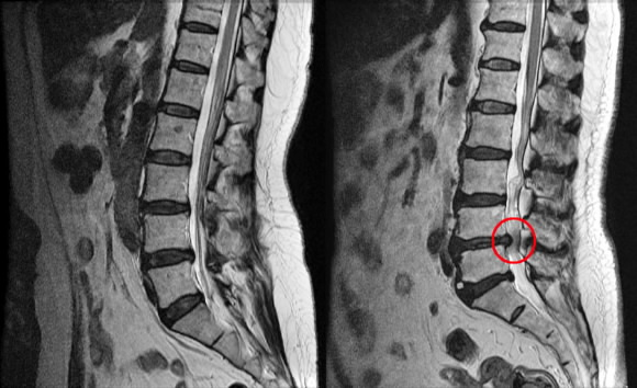 정상척추(왼쪽)·척추관협착증(○표 부분)