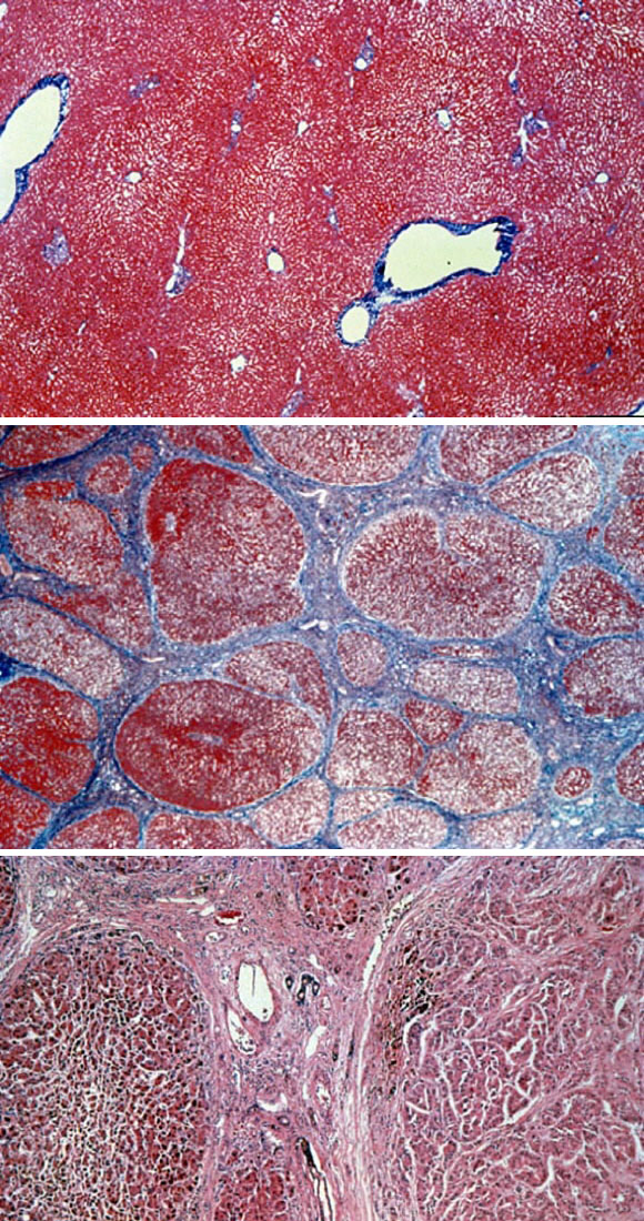 건강한 간 조직. 간경변증으로 악화된 간 조직. 간암으로 악화된 간 조직(위부터).
