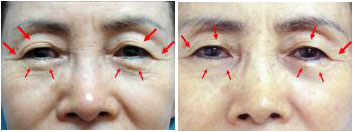 고주파열을 이용한 써마지요법으로 상안검이완증을 치료한 사례. 늘어진 눈꺼풀(왼쪽)을 수술 대신 써마지요법로 치료해 원래의 모습(오른쪽)에 가까운 효과를 얻을 수 있다.