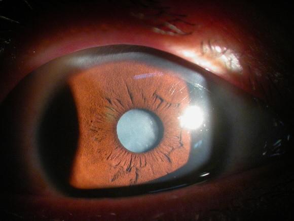 20대 중증 백내장 환자의 안구. 수정체가 완전히 백색으로 변한 모습이다.