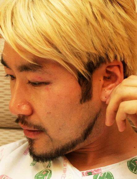 폭행 상처 공개하는 노홍철 연합뉴스