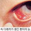 ‘눈 다래끼’ 전염병이 아니에요