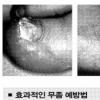 무좀, 식초의 추억 잊어라