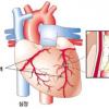 막힌 혈관 대체하는 우회술 보편화