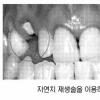 임플란트 앞서 ‘자연치 소생술’ 고려를