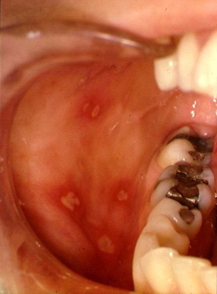 수족구병으로 입 안에 생긴 발진