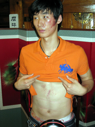 배구 국가대표팀 박철우가 18일 서울 압구정동의 한 음식점에서 기자회견을 열고 피멍이 든 얼굴과 복부를 드러내 보이고 있다. 연합뉴스