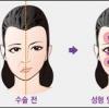 안면마비성형, 아름다운 얼굴을 되찾아 주는 마이더스의 손