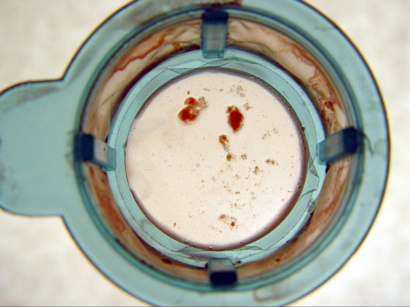 혈관 속의 혈전을 촬영한 모습.